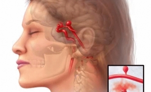 Cюжет в программе "Панорама дня" на телеканале СТВ, посвященный удалению гигантской аневризмы в сосудистом отделении Национального центра нейрохирургии