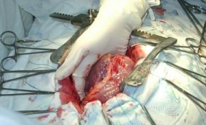 Плюс одна жизнь или новое сердце!