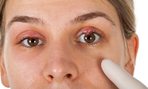 теріскен, Көздің аурулары