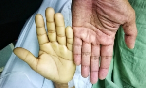 Анемия – қанда оттегіні ағзаларға негізгі жеткізушілер.